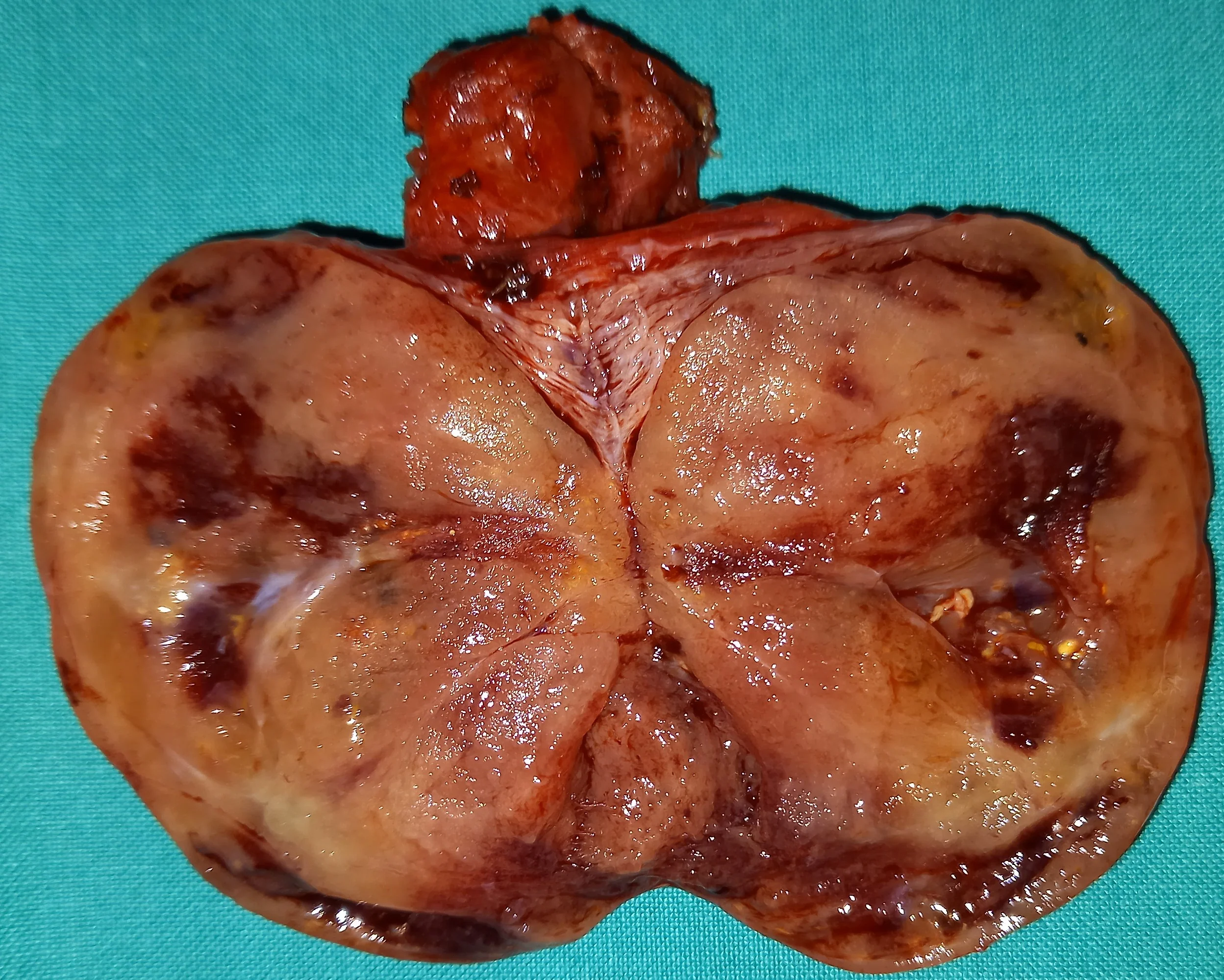 CROSS SECTION RIGHT THYROID LOBE