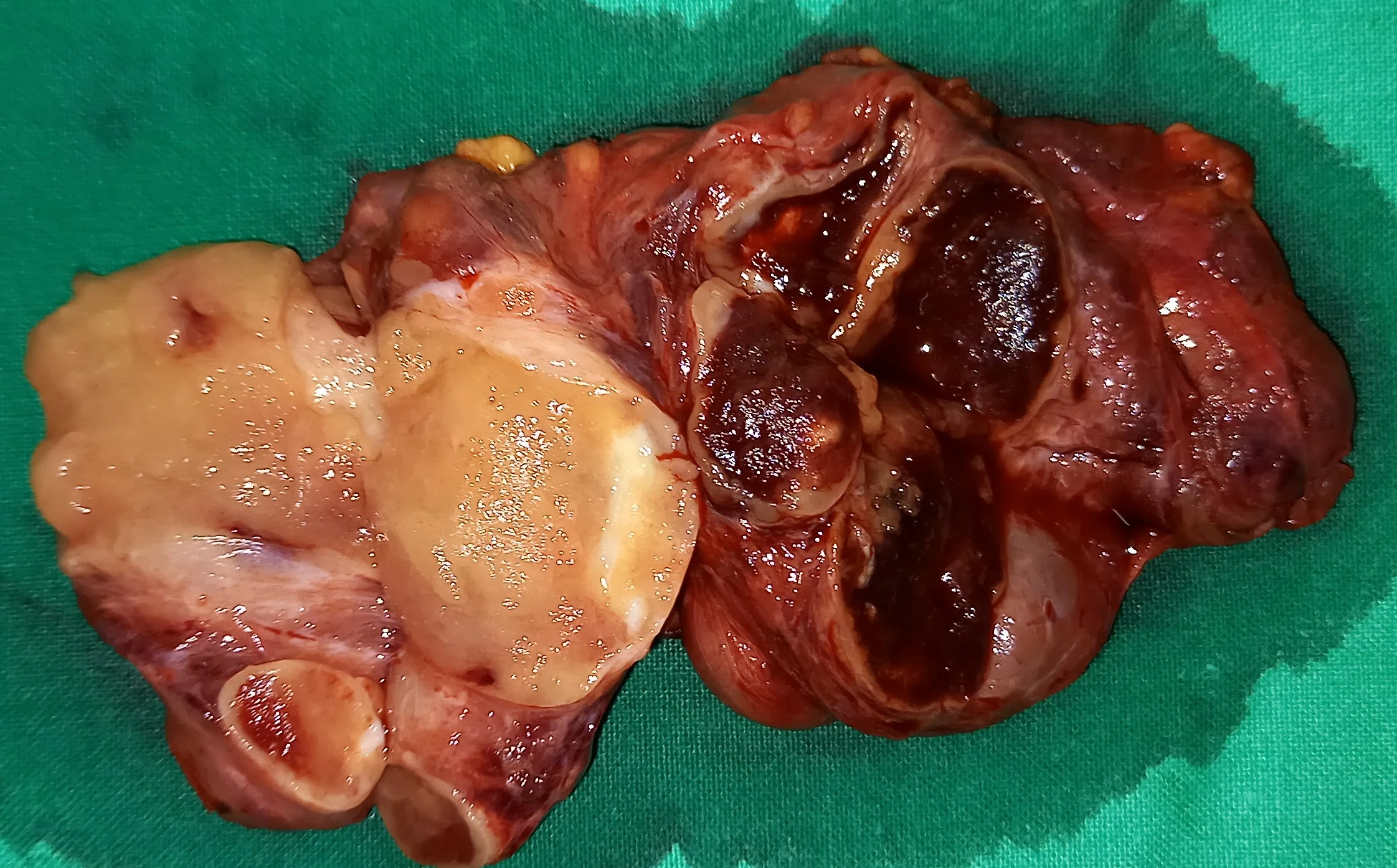 THYROID GOITER 