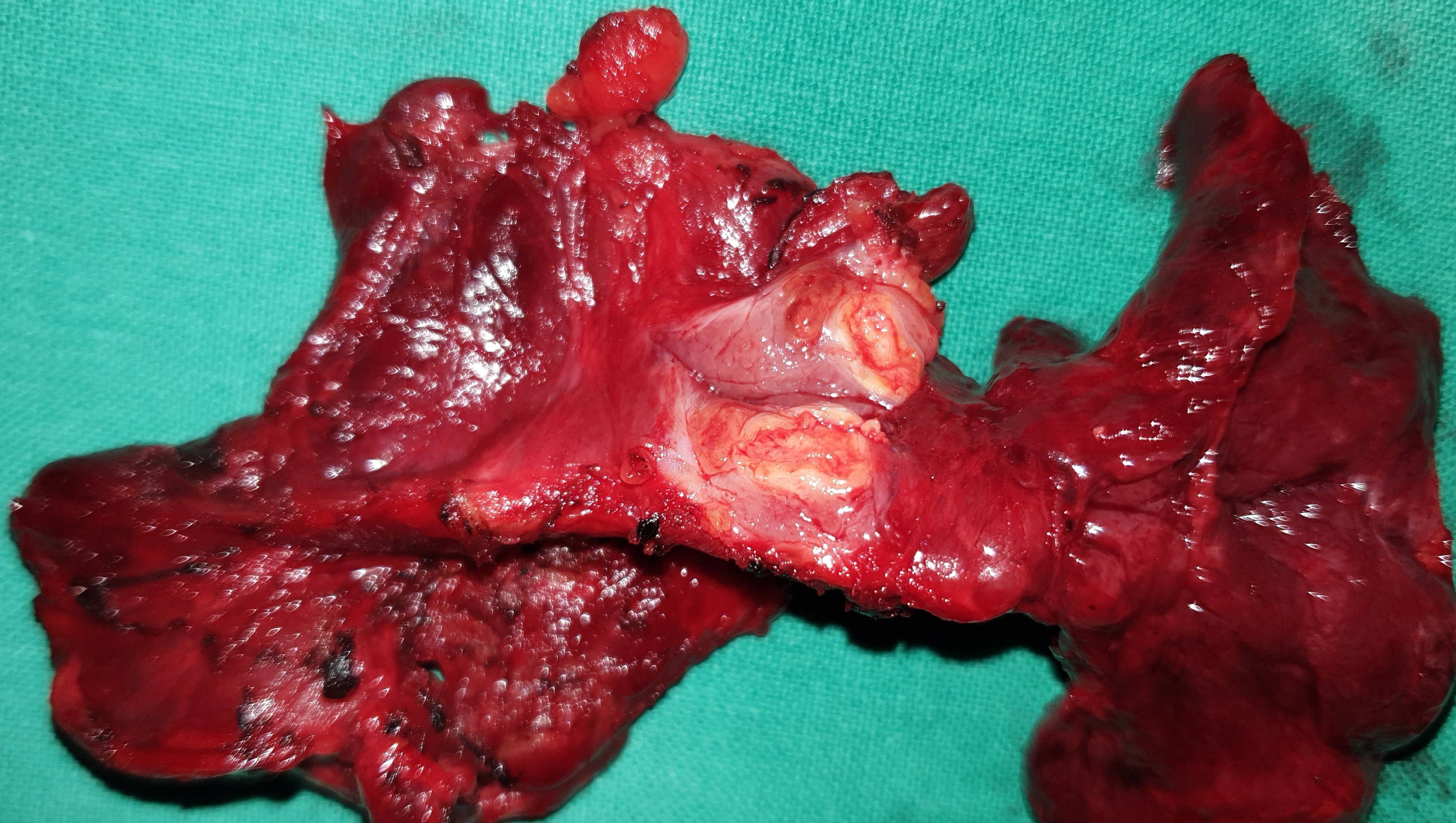 ISTHMUS PAPILLARY THYROID CARCINOMA