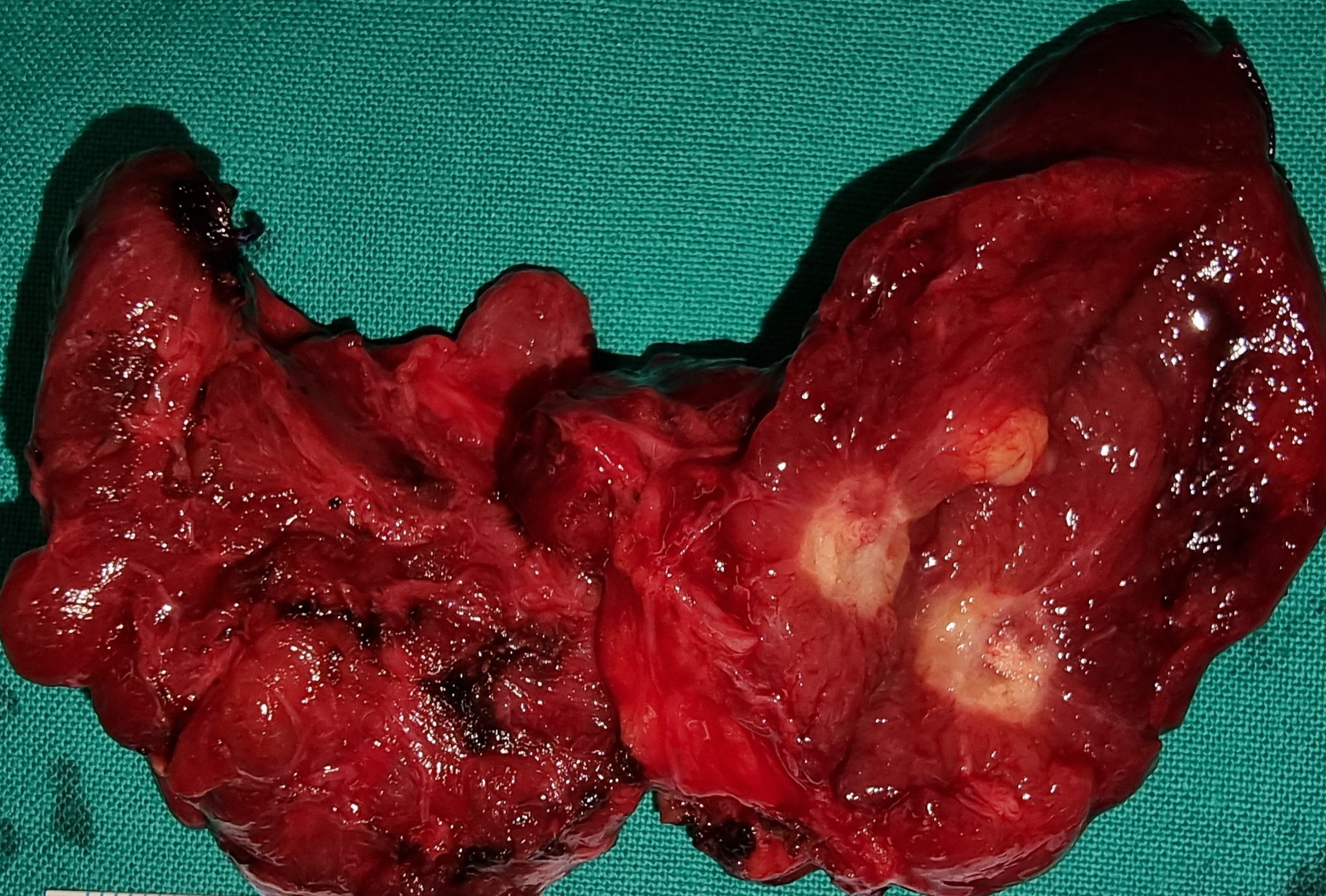 PAPILLARY THYROID CARCINOMA