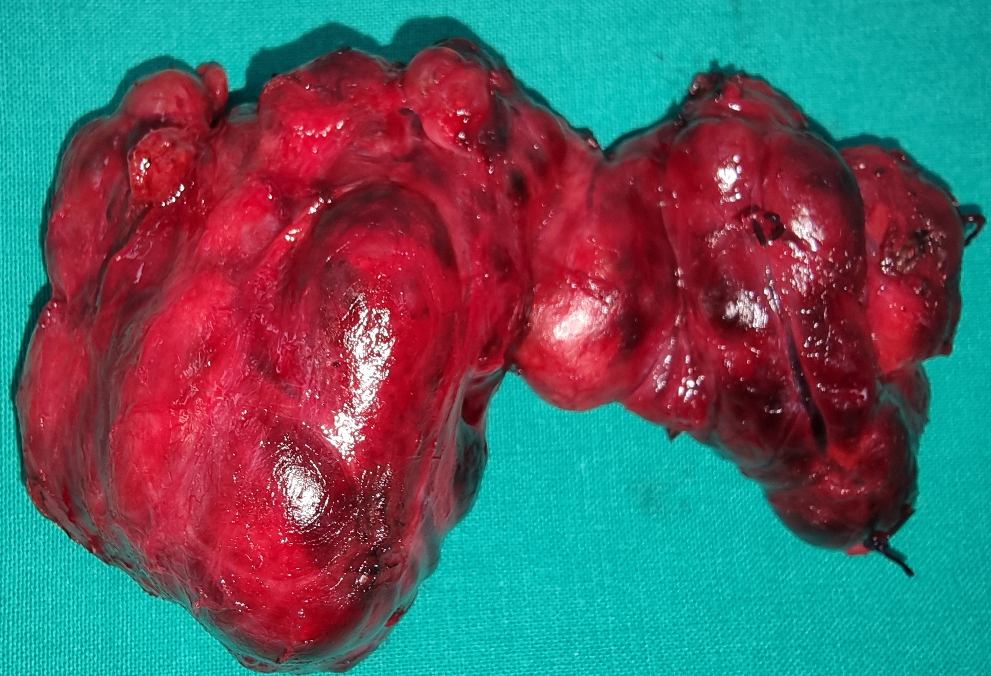 THYROID GOITER