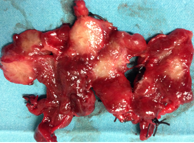 PAPILLARY THYROID CARCINOMA