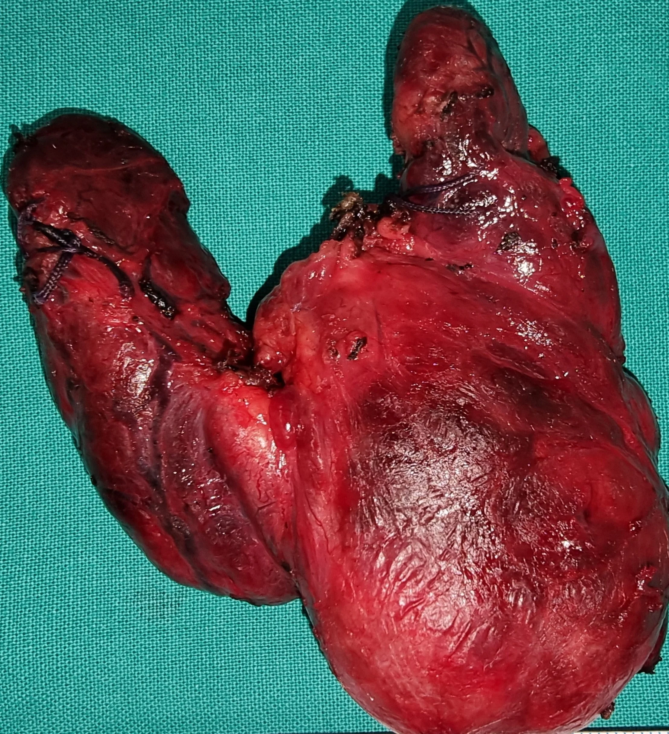 TOXIC GOITER