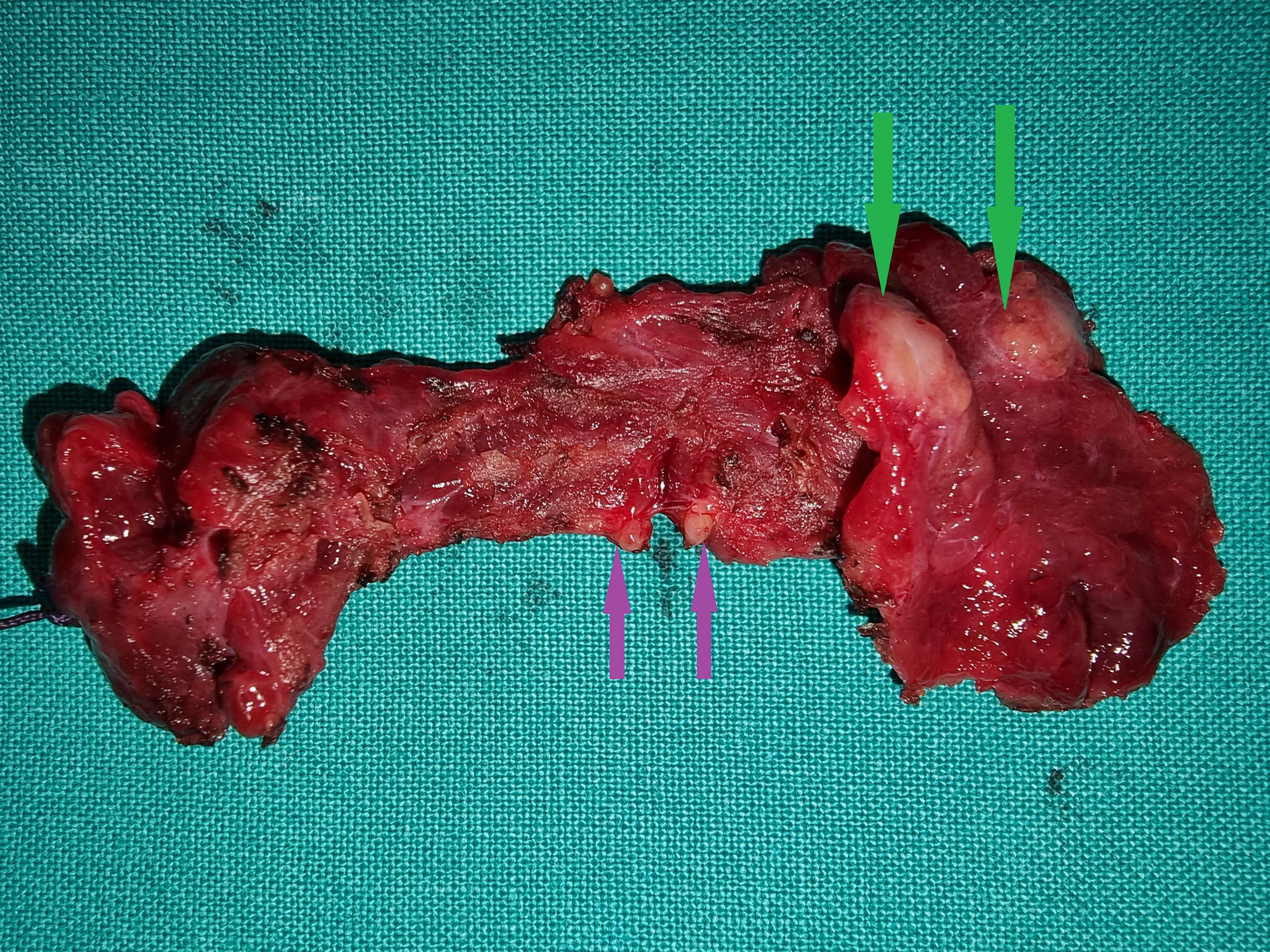 PAPILLARY THYROID CARCINOMA + INFILTRATED LYMPH NODES