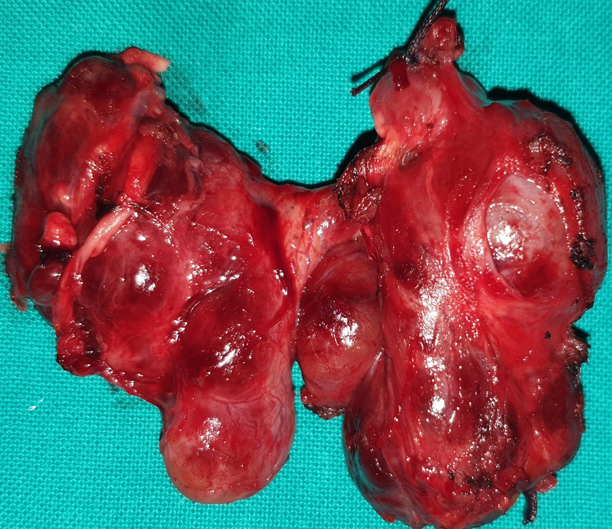 THYROID LYMPHOMA