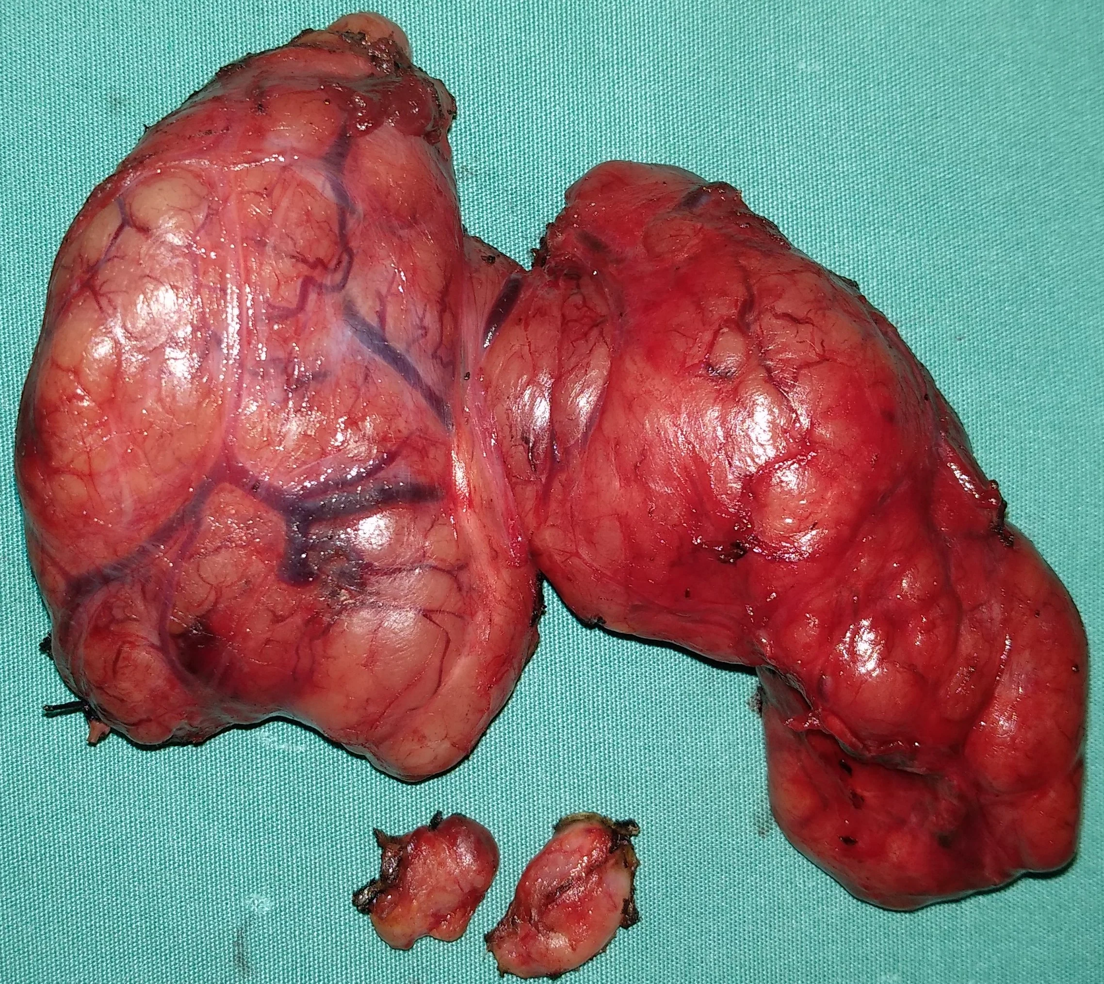 TOXIC ADENOMA