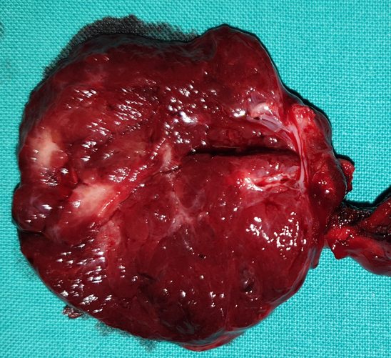 PAPILLARY THYROID CARCINOMA
