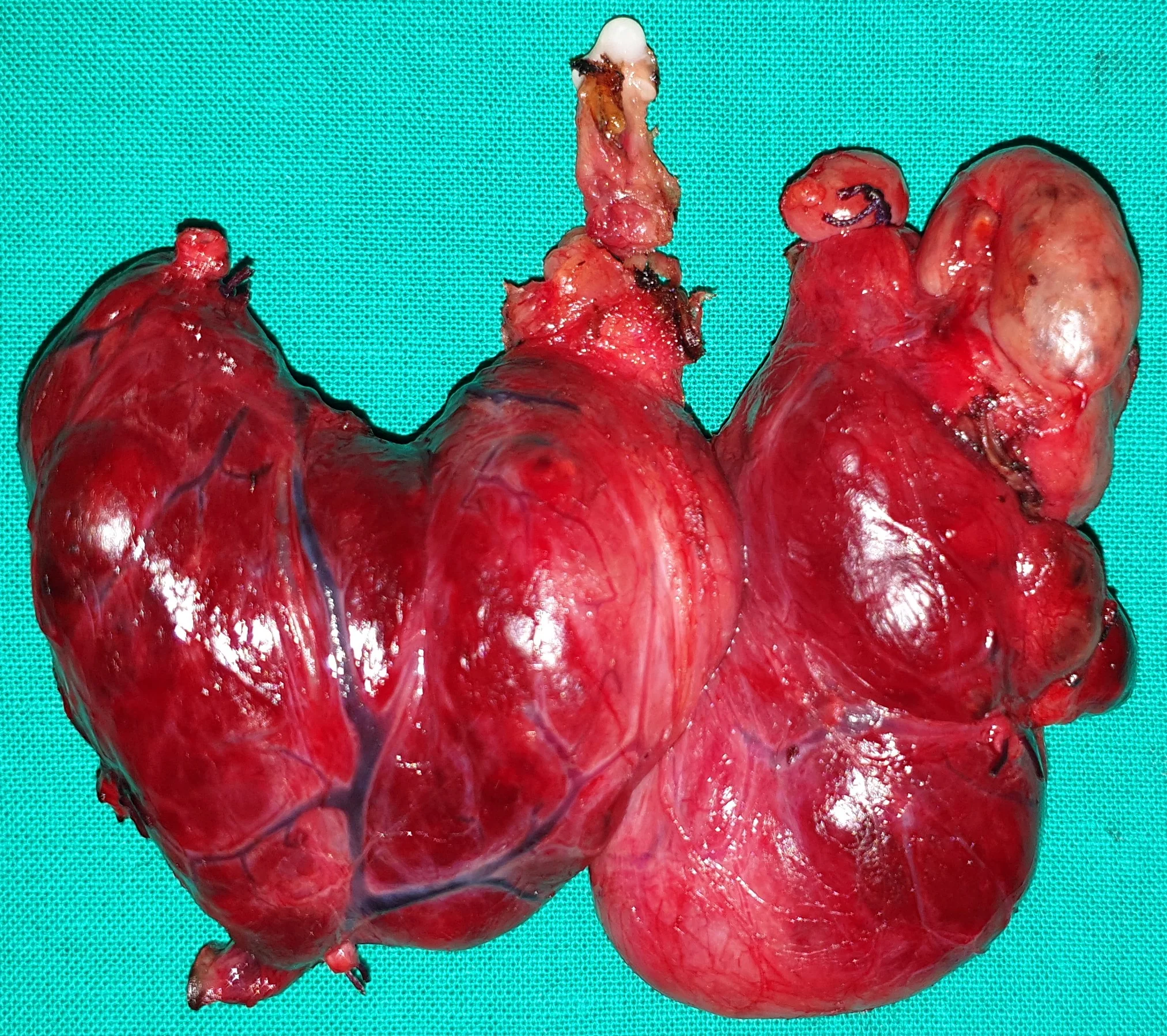 MULTINODULAR GOITER