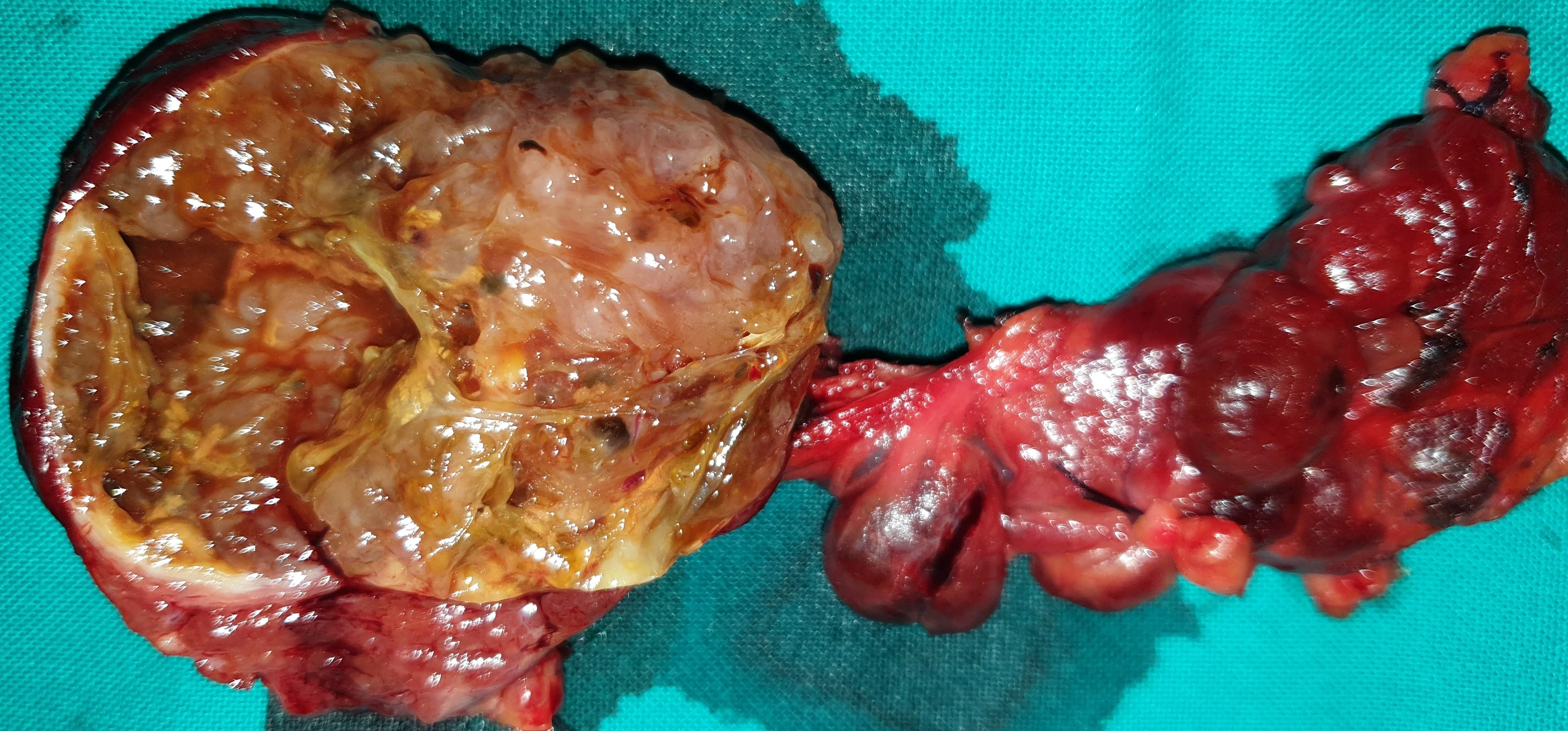 CYSTIC DEGENERATION 