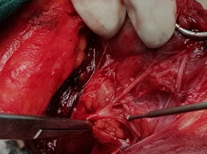 GALEN'S ANASTOMOSIS 