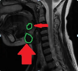 DOUBLE THYROID ECTOPIA