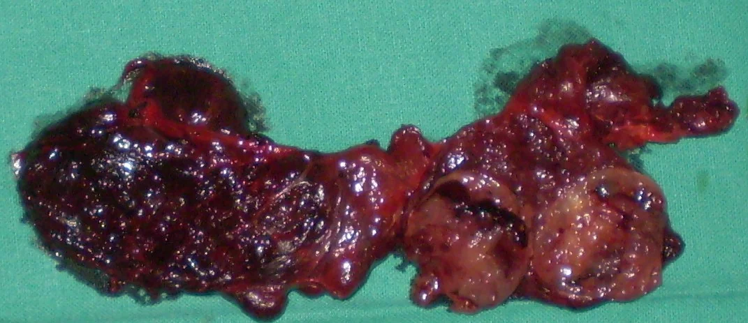 DIFFUSE TOXIC GOITER