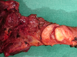 PAPILLARY THYROID CARCINOMA OF THE ISTHMUS