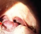LINGUAL THYROID