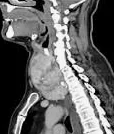 RETROSTERNAL GOITER