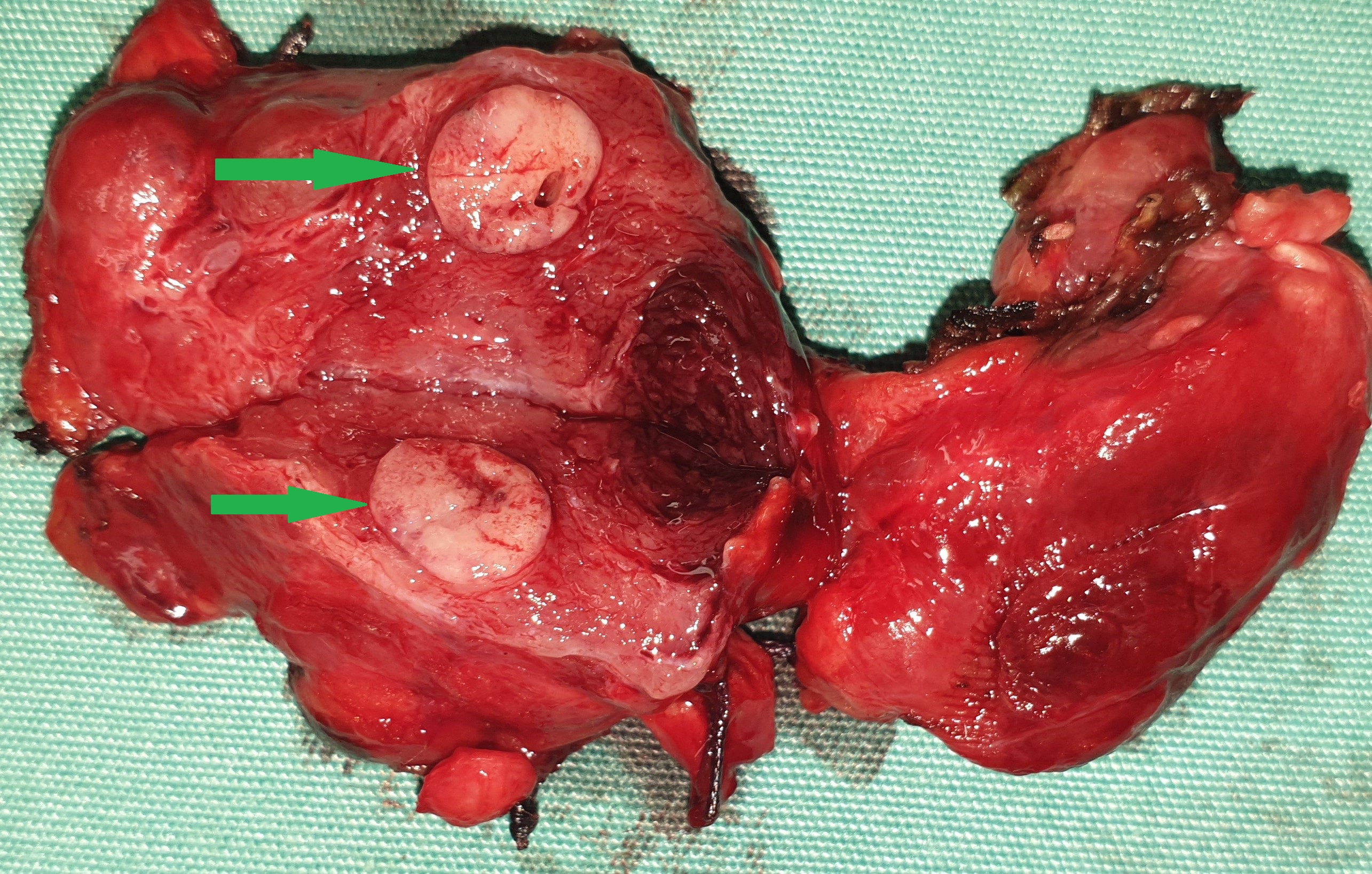 SPORADIC MEDULLARY THYROID CARCINOMA