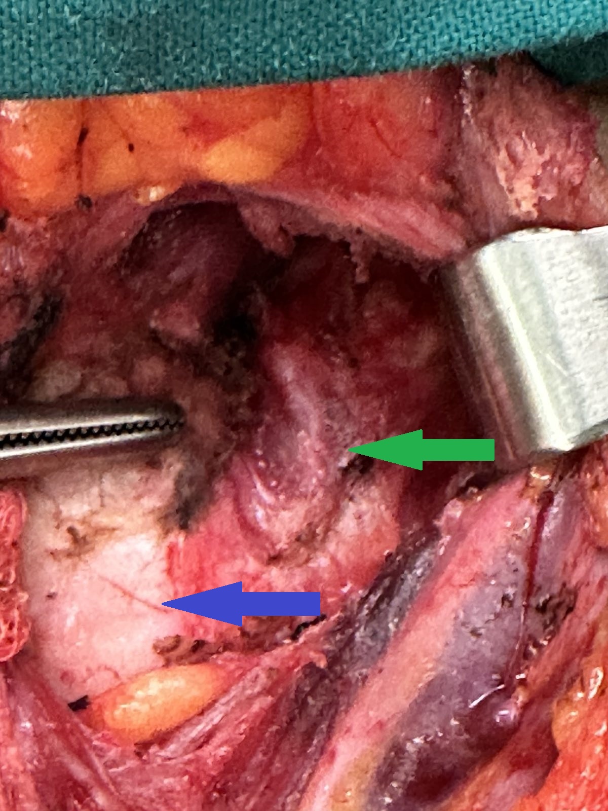LEFT INFERIOR RECURRENT LARYNGEAL NERVE