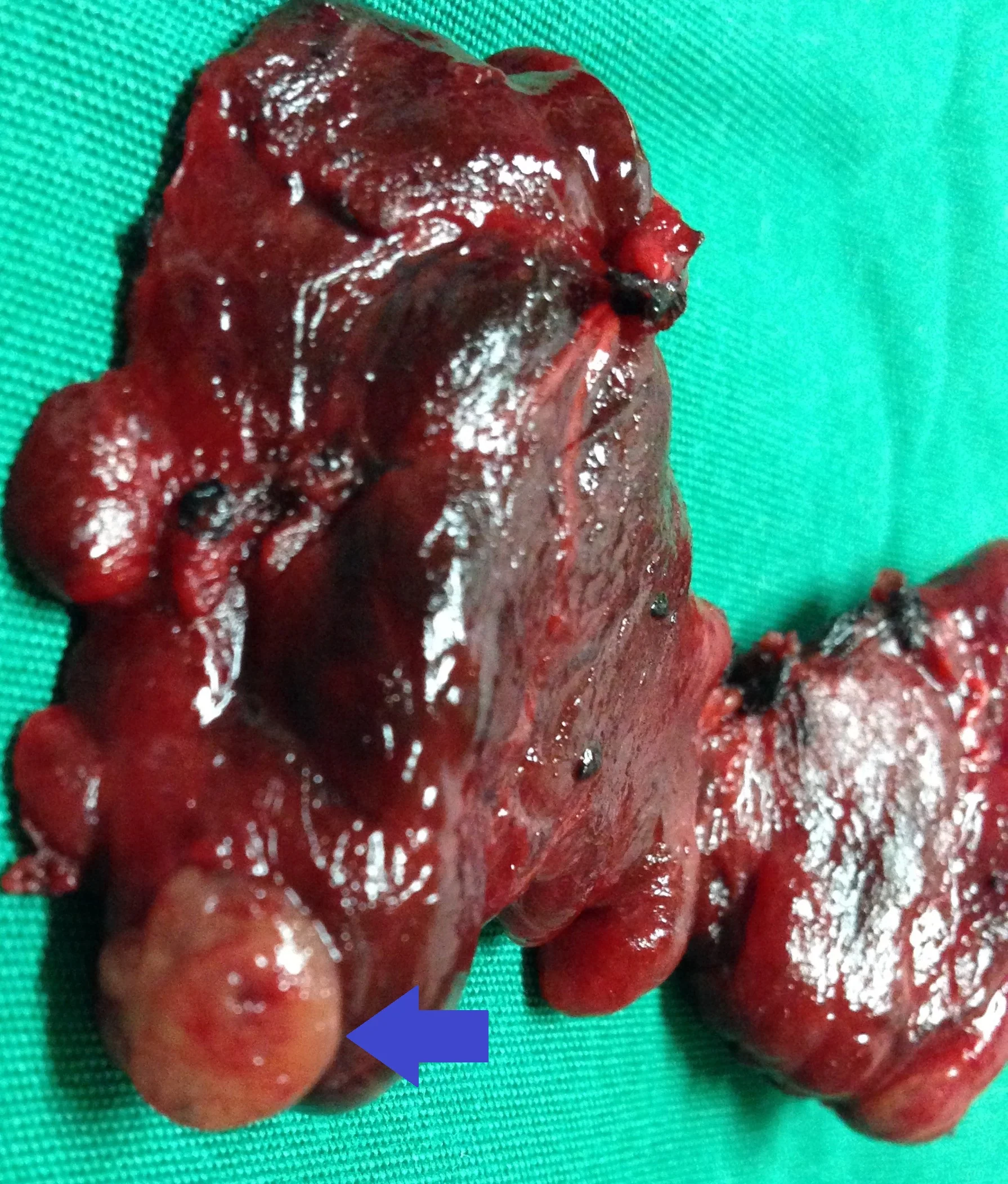 INTRATHYROIDAL PARATHYROID ADENOMA