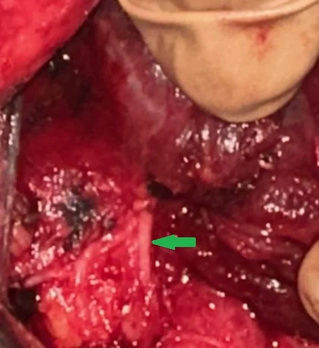 RIGHT INFERIOR LARYNGEAL NERVE DESOMPRESSION