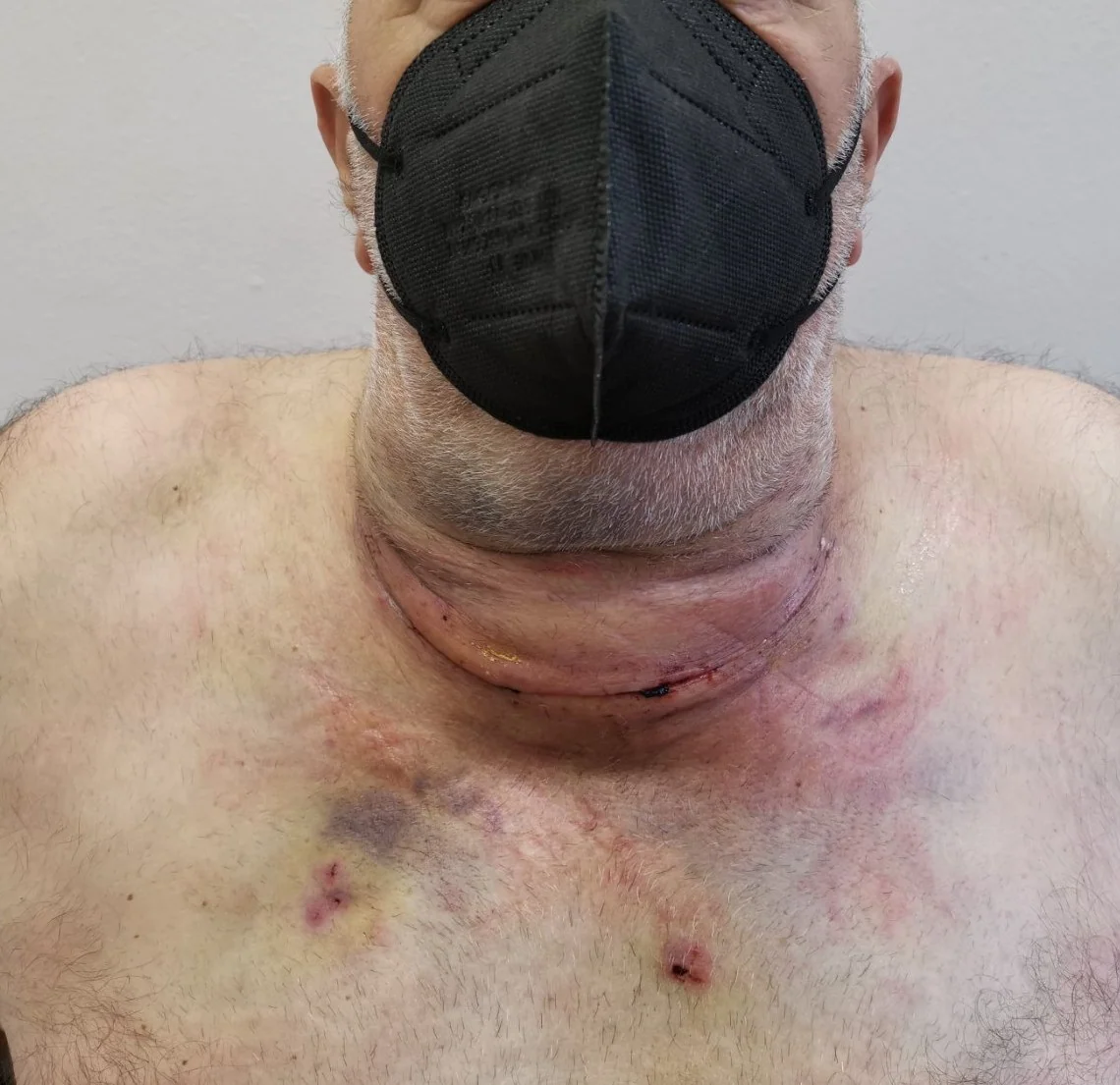 POST OPERATIVE HEMATOMA - HIGH DOSE HEPARIN