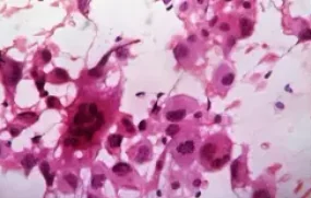 ANAPLASTIC CARCINOMA