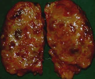 ANAPLASTIC THYROID CARCINOMA