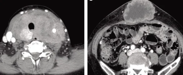 ANAPLASTIC THYROID CARCINOMA - ABDOMINAL METASTASIS