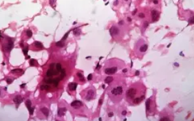 ANAPLASTIC THYROID CARCINOMA