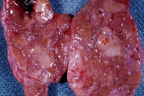 BURKITT THYROID LYMPHOMA