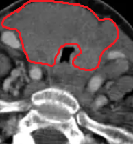BURKITT THYROID LYMPHOMA