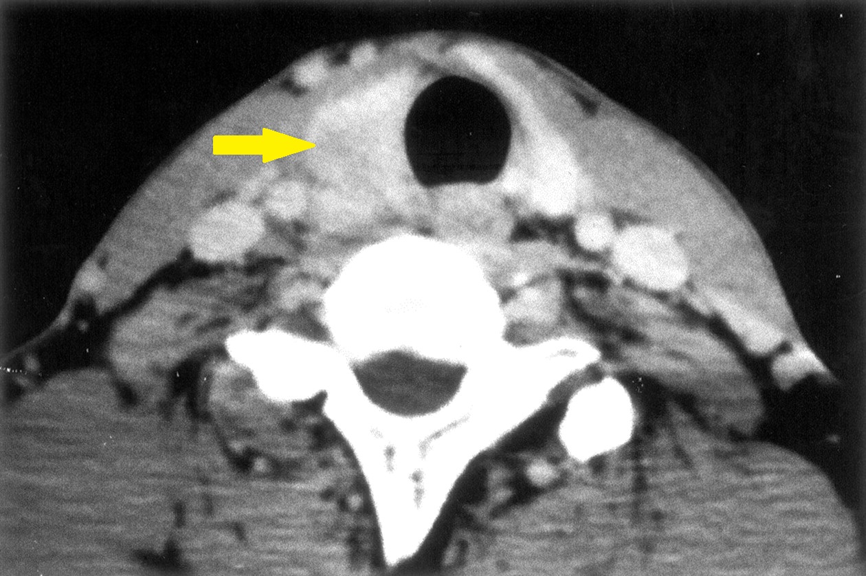 DE QUERVAIN'S THYROIDITIS