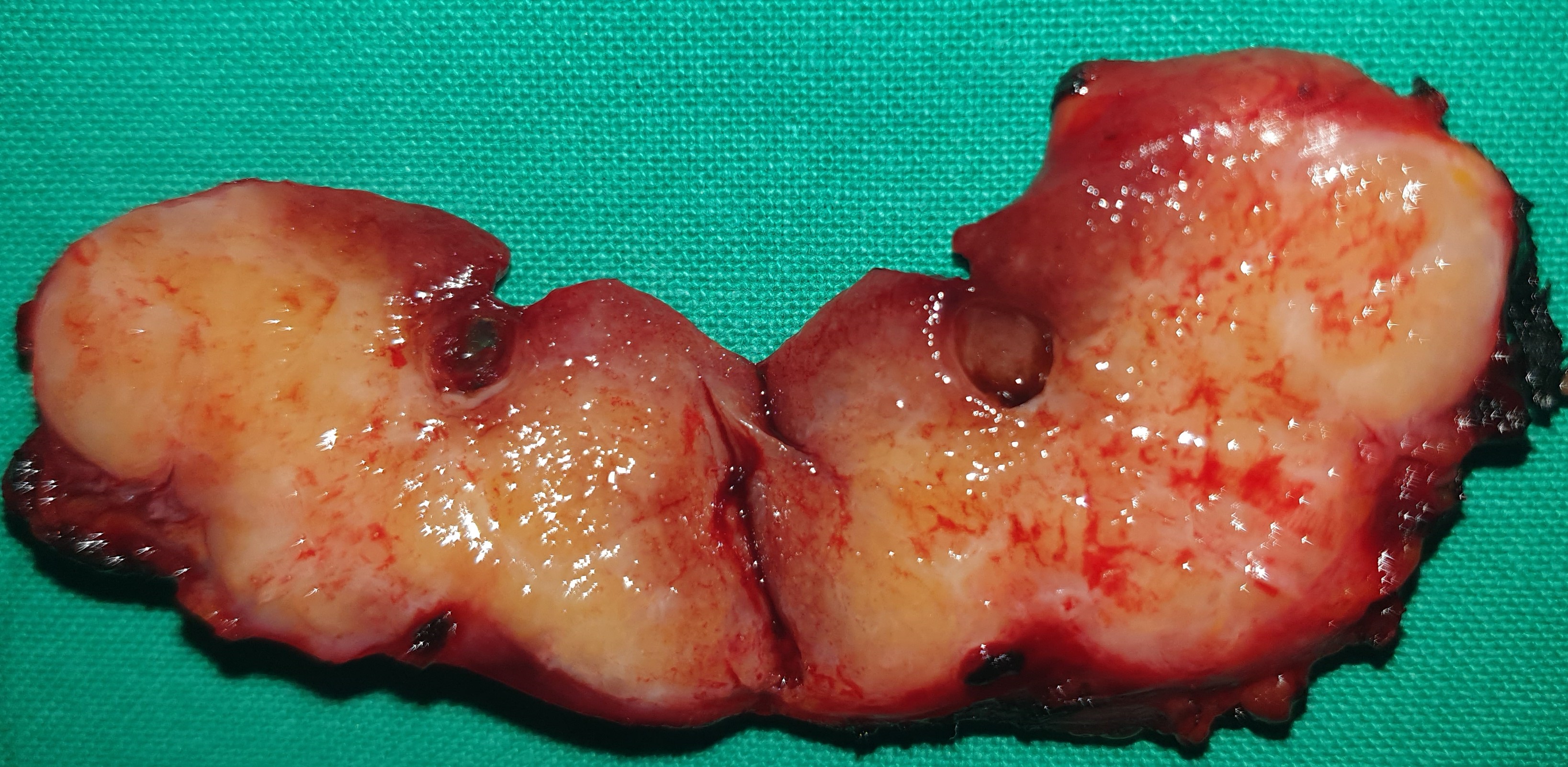 DE QUERVAIN'S THYROIDITIS