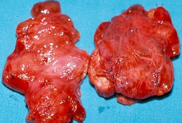 THYROID GOITER