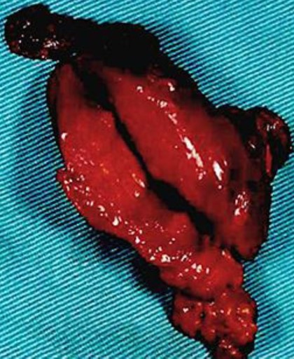 DIFFUSE SCLEROSING PAPILLARY THYROID CARCINOMA