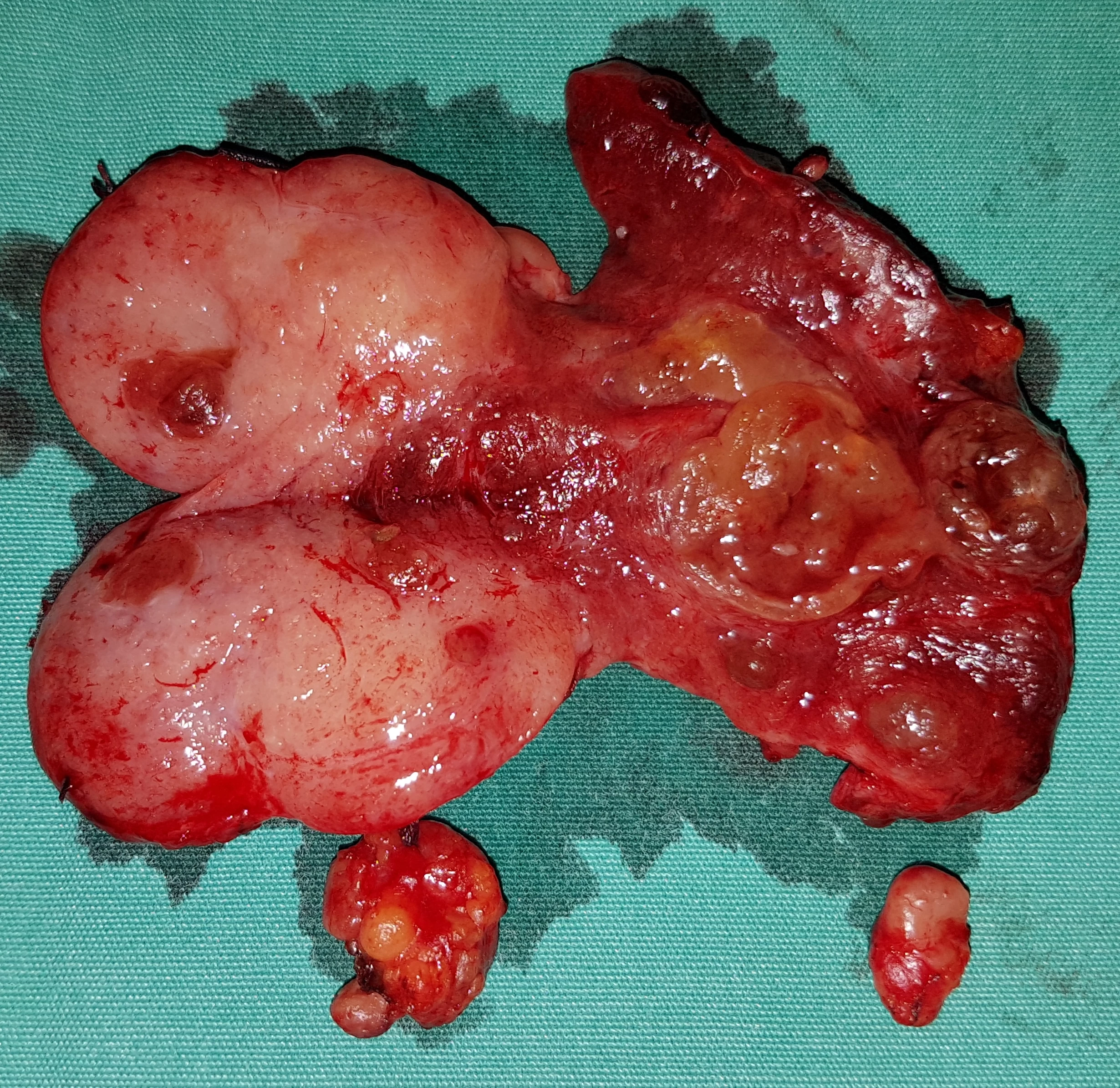 DIFFUSE SCLEROSING PAPILLARY THYROID CARCINOMA
