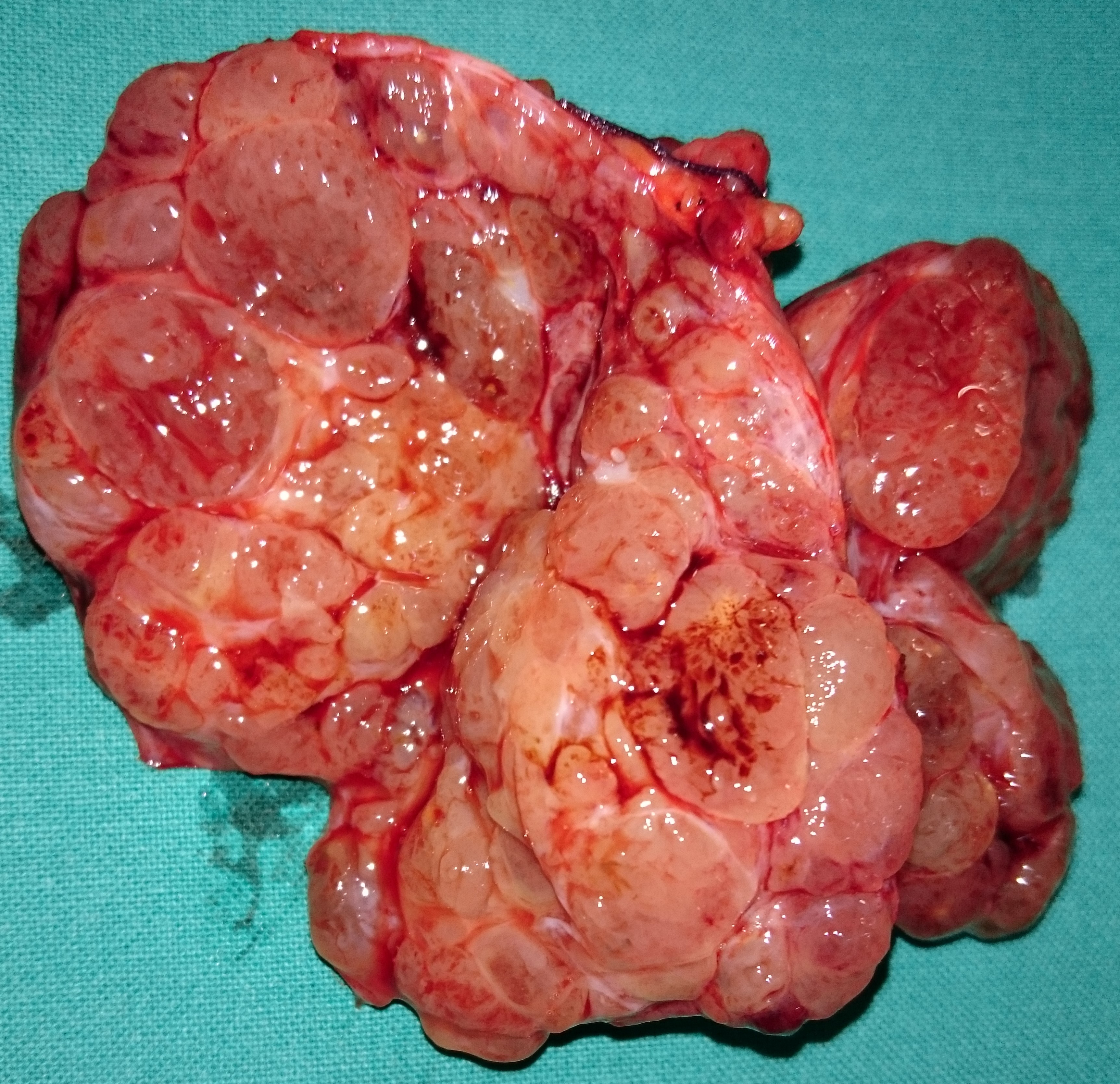 THYROID GOITER 