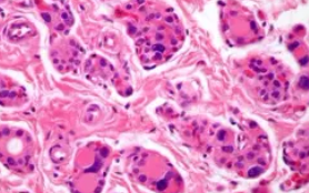 DYSHORMONOGENETIC GOITER