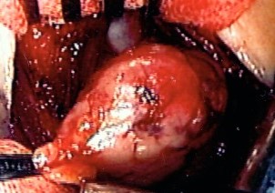 ECTOPIC THYMOMA LOWER THYROID POLE