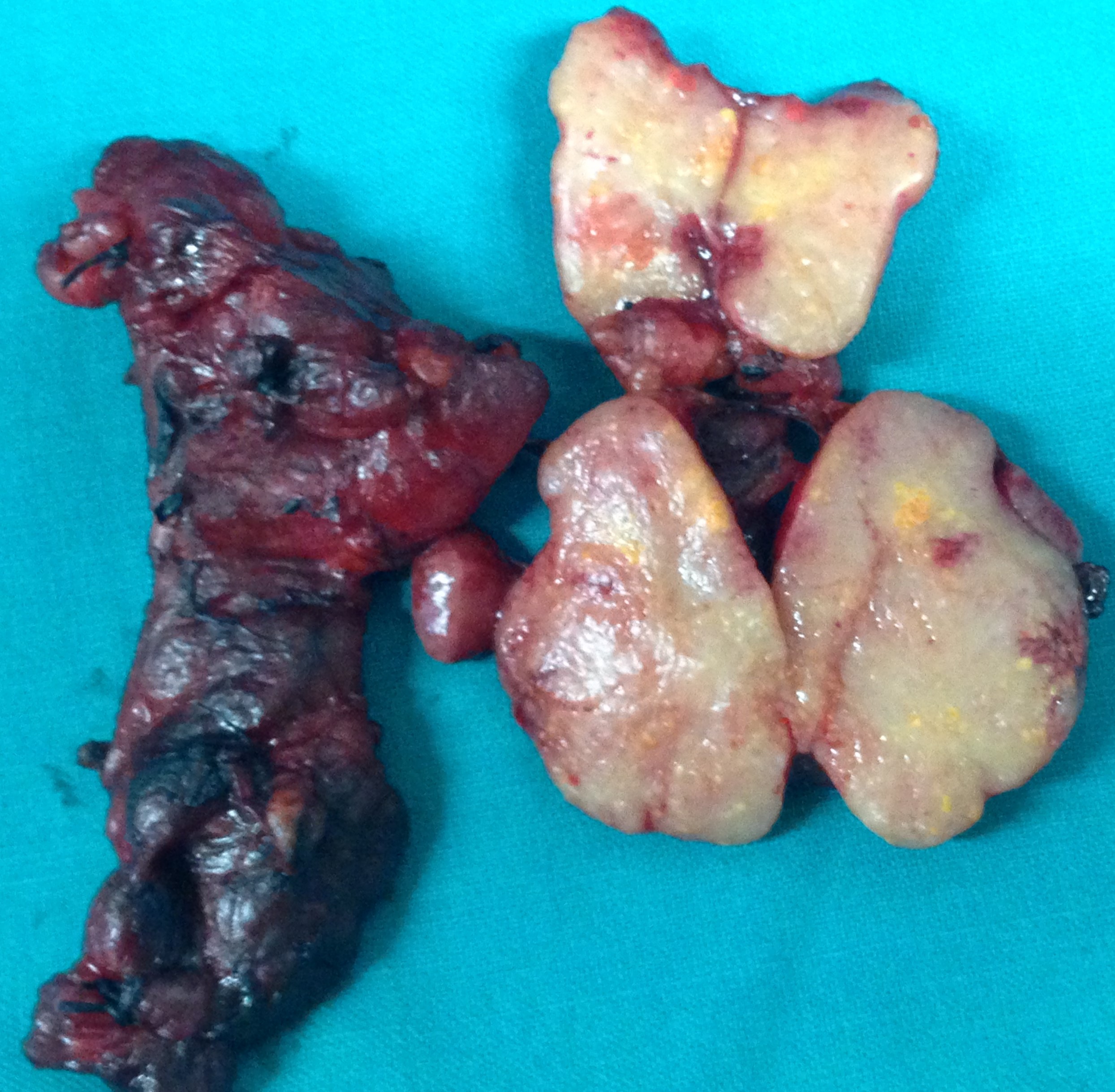 FOLLICULAR THYROID CARCINOMA