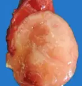 FOLLICULAR THYROID ADENOMA