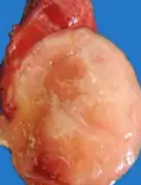 FOLLICULAR ADENOMA