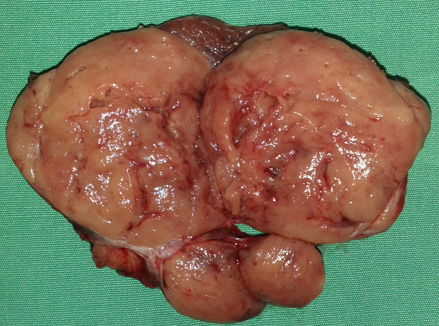 FOLLICULAR THYROID CARCINOMA