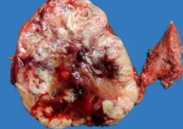 FOLLICULAR THYROID CARCINOMA