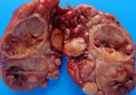 FOLLICULAR CARCINOMA