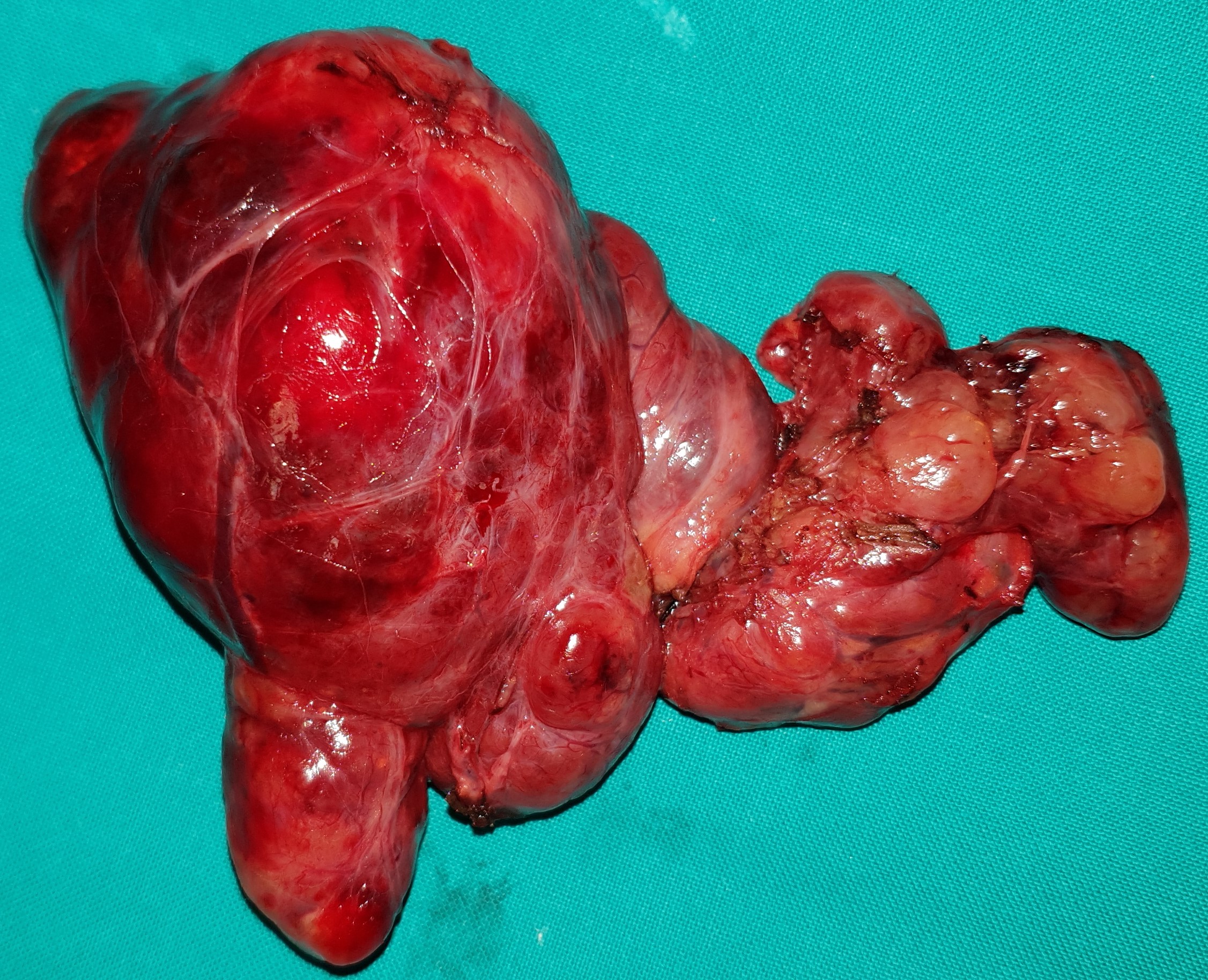 THYROID GOITER