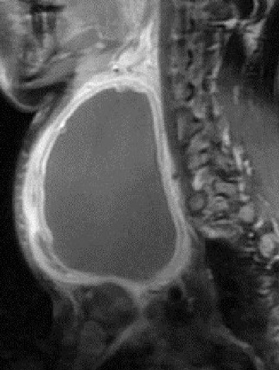 THYROID ABSCESS