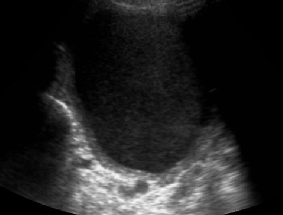 THYROID ABSCESS