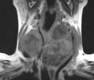 THYROID GOITER