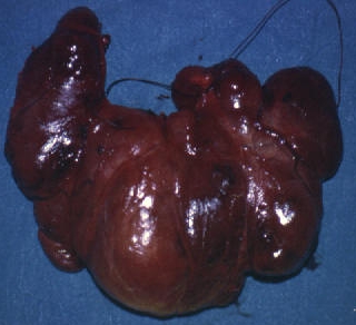 THYROID GOITER