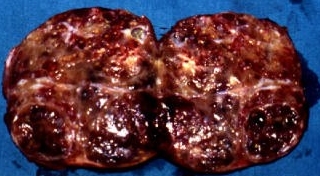 THYROID GOITER